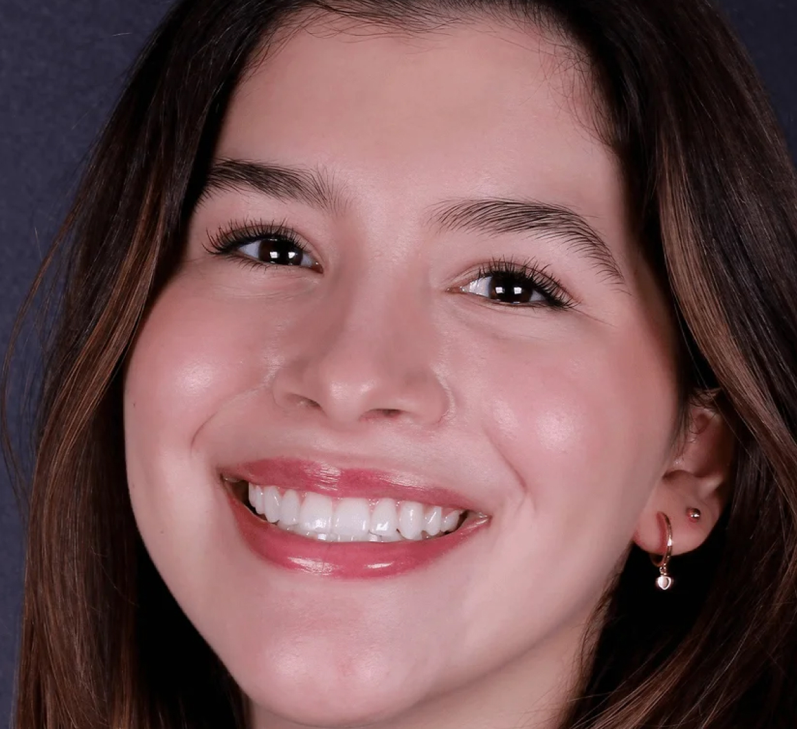 Sonrisa diseñada por Visage Experts